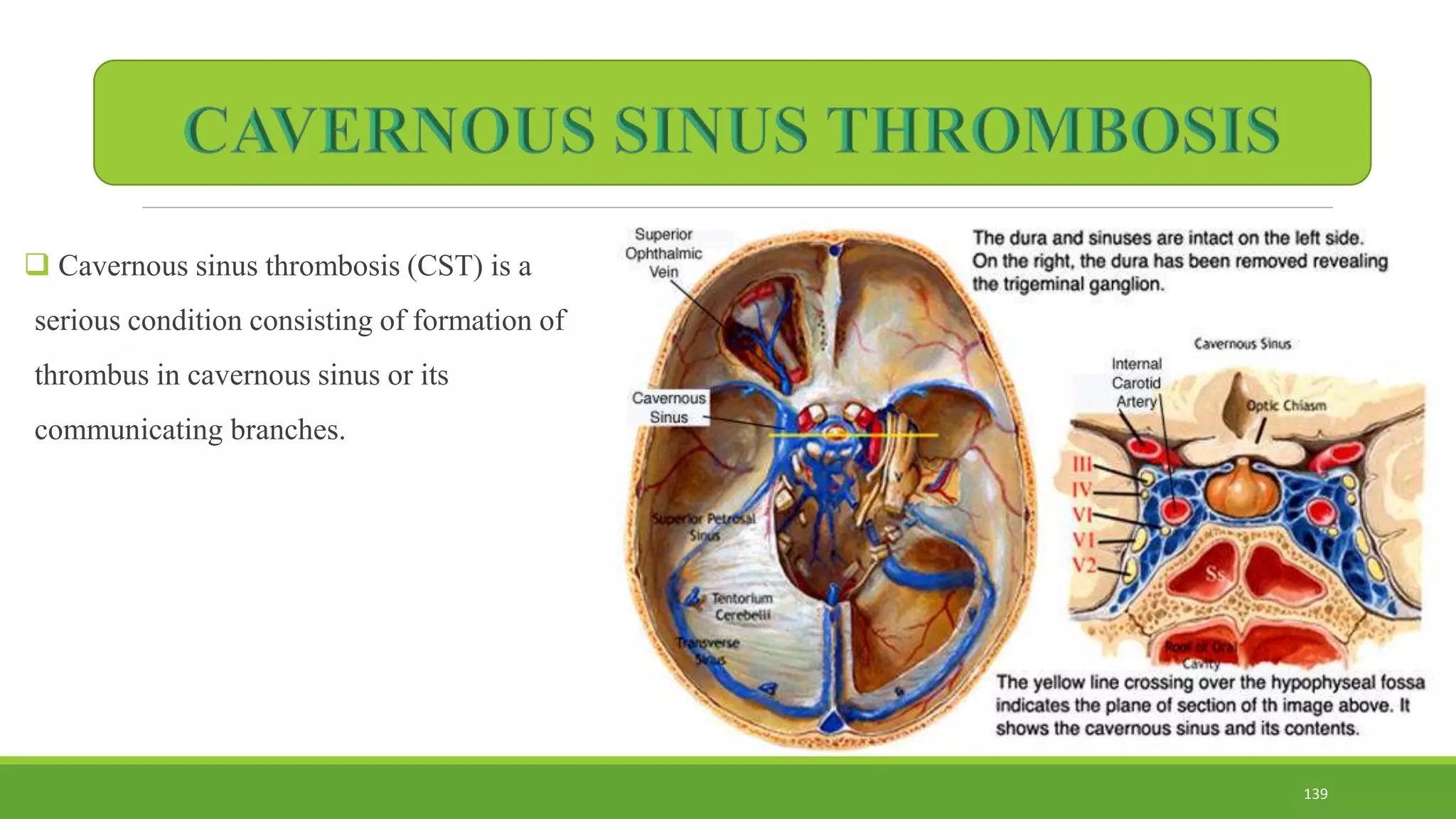  Cavernous sinus thrombosis (CST) is a
serious condition consisting of formation of
thrombus in cavernous sinus or its
communicating branches.
139
 