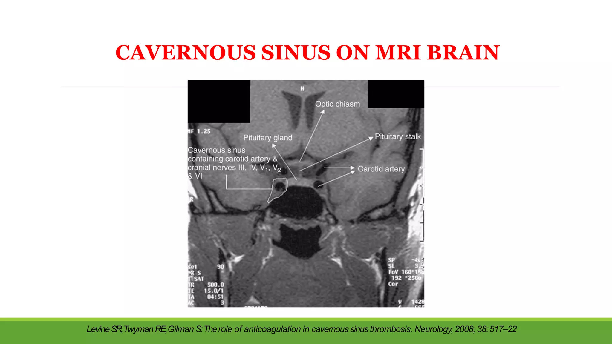 CAVERNOUS SINUS ON MRI BRAIN
LevineSR,TwymanRE,Gilman S:Therole of anticoagulation in cavernoussinusthrombosis. Neurology, 2008; 38:517–22
 