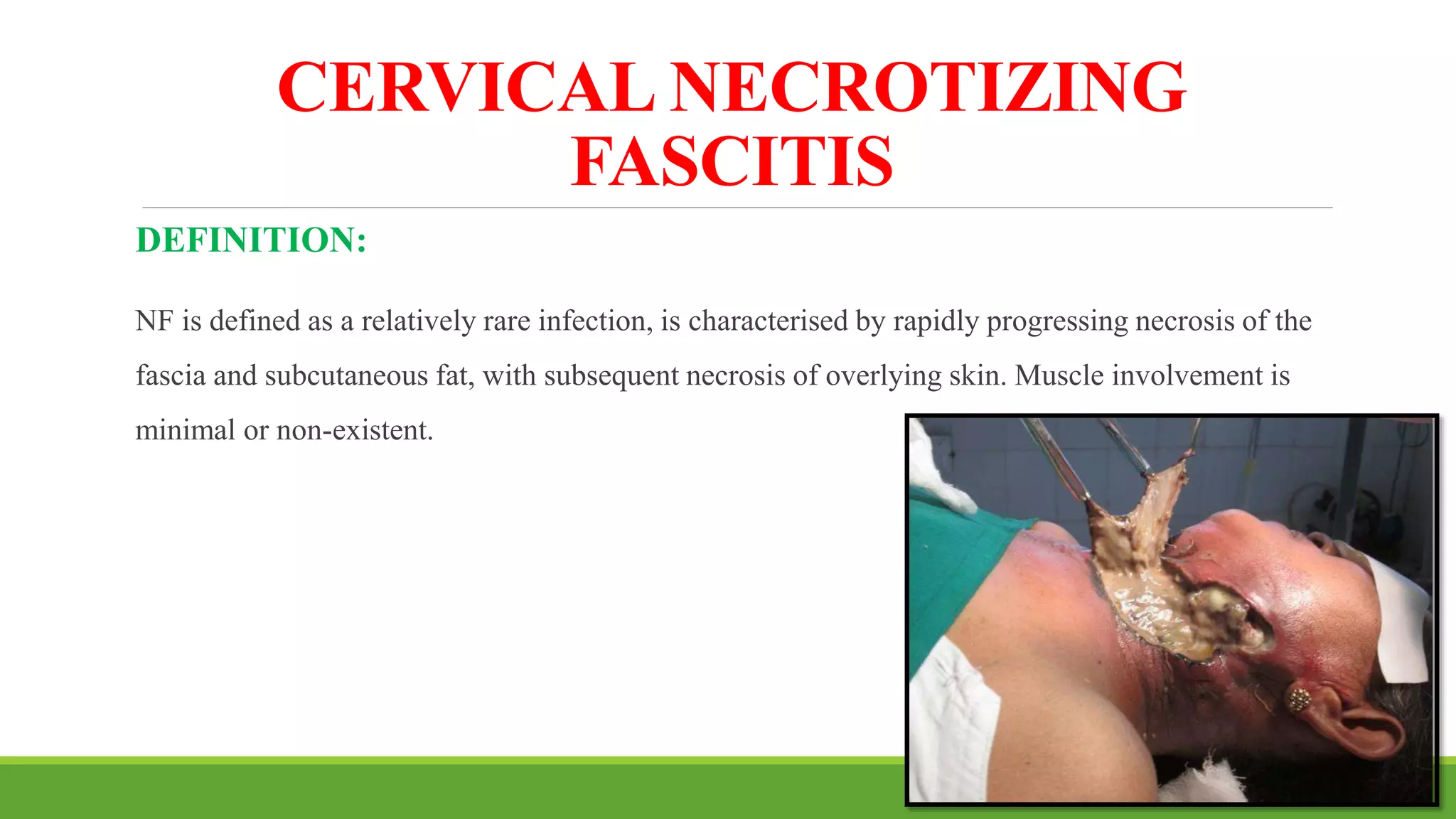 CERVICAL NECROTIZING
FASCITIS
DEFINITION:
NF is defined as a relatively rare infection, is characterised by rapidly progressing necrosis of the
fascia and subcutaneous fat, with subsequent necrosis of overlying skin. Muscle involvement is
minimal or non-existent.
164
 