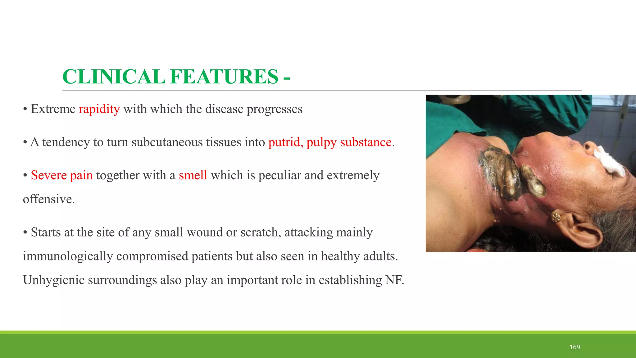 CLINICAL FEATURES -
• Extreme rapidity with which the disease progresses
• A tendency to turn subcutaneous tissues into putrid, pulpy substance.
• Severe pain together with a smell which is peculiar and extremely
offensive.
• Starts at the site of any small wound or scratch, attacking mainly
immunologically compromised patients but also seen in healthy adults.
Unhygienic surroundings also play an important role in establishing NF.
169
 