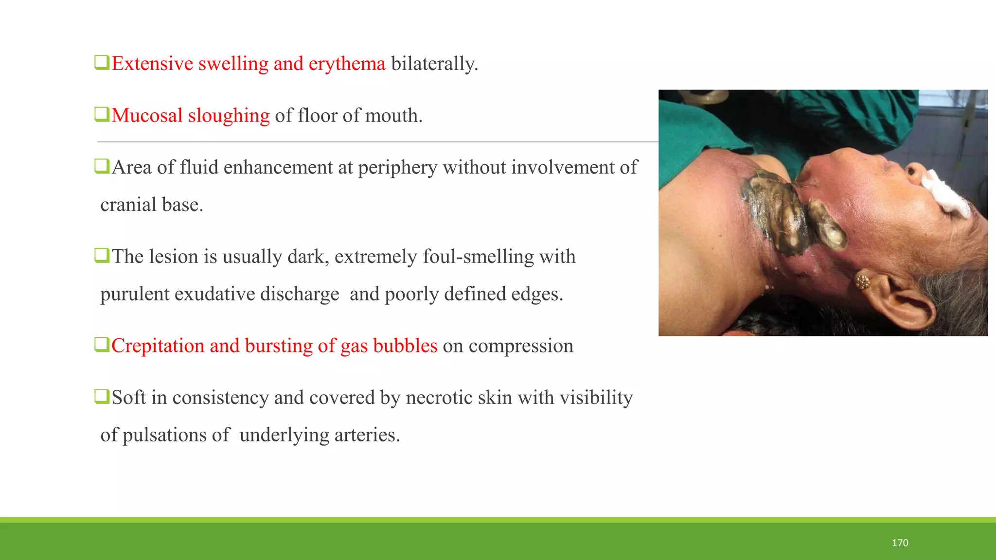 Extensive swelling and erythema bilaterally.
Mucosal sloughing of floor of mouth.
Area of fluid enhancement at periphery without involvement of
cranial base.
The lesion is usually dark, extremely foul-smelling with
purulent exudative discharge and poorly defined edges.
Crepitation and bursting of gas bubbles on compression
Soft in consistency and covered by necrotic skin with visibility
of pulsations of underlying arteries.
170
 