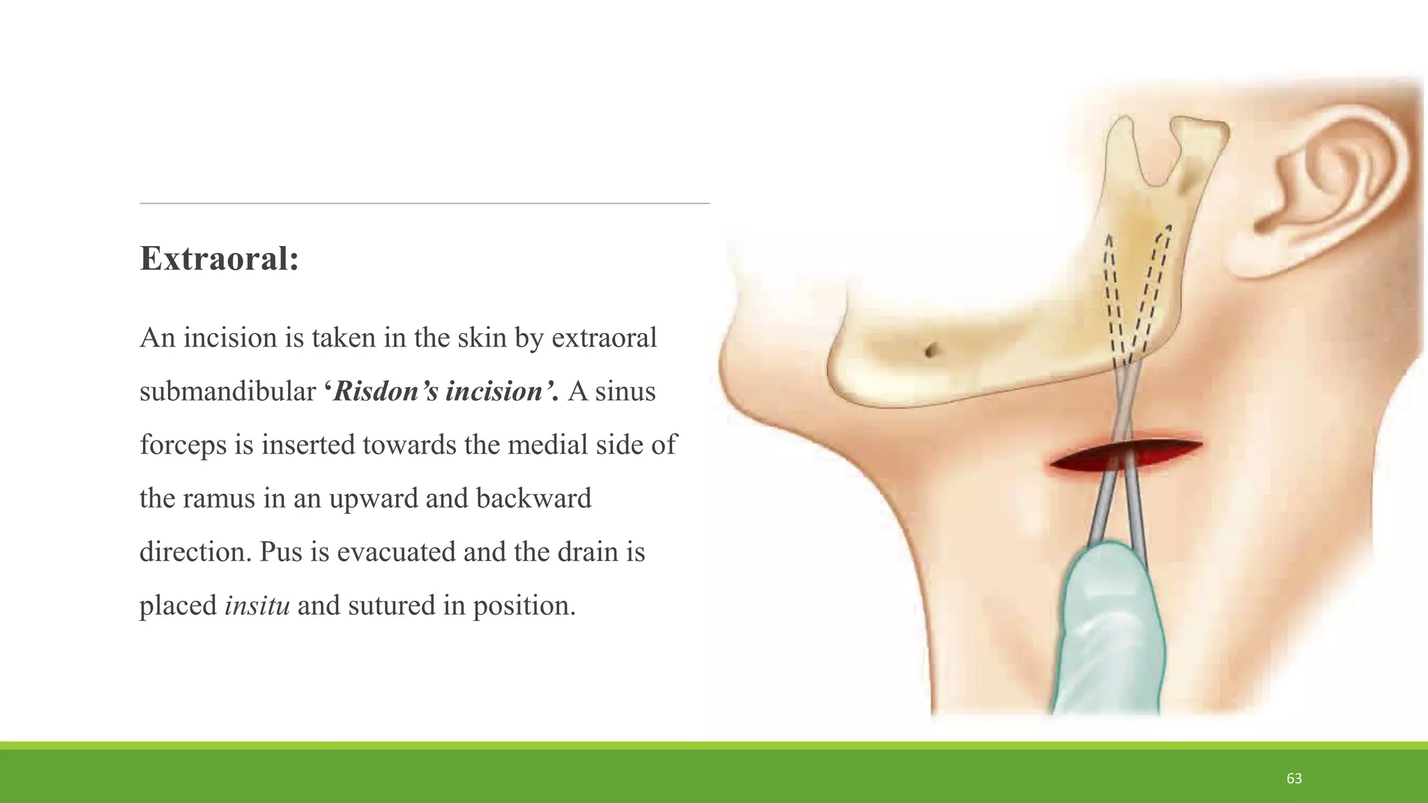 Extraoral:
An incision is taken in the skin by extraoral
submandibular ‘Risdon’s incision’. A sinus
forceps is inserted towards the medial side of
the ramus in an upward and backward
direction. Pus is evacuated and the drain is
placed insitu and sutured in position.
63
 