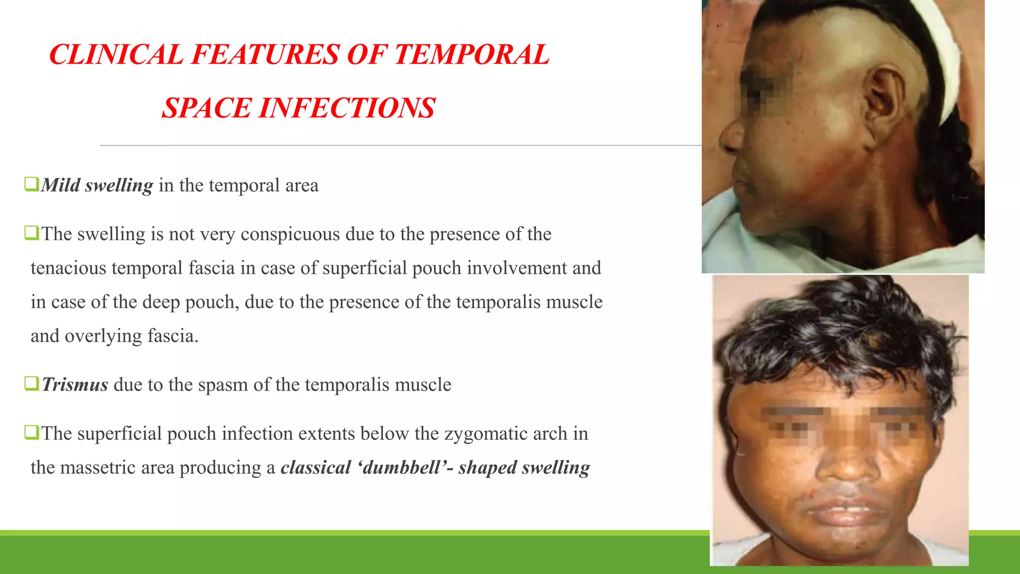 CLINICAL FEATURES OF TEMPORAL
SPACE INFECTIONS
Mild swelling in the temporal area
The swelling is not very conspicuous due to the presence of the
tenacious temporal fascia in case of superficial pouch involvement and
in case of the deep pouch, due to the presence of the temporalis muscle
and overlying fascia.
Trismus due to the spasm of the temporalis muscle
The superficial pouch infection extents below the zygomatic arch in
the massetric area producing a classical ‘dumbbell’- shaped swelling
70
 