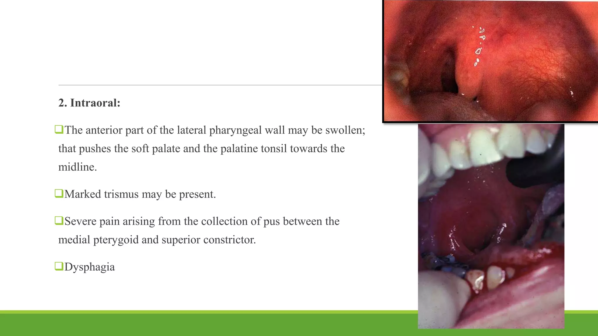 2. Intraoral:
The anterior part of the lateral pharyngeal wall may be swollen;
that pushes the soft palate and the palatine tonsil towards the
midline.
Marked trismus may be present.
Severe pain arising from the collection of pus between the
medial pterygoid and superior constrictor.
Dysphagia
82
 