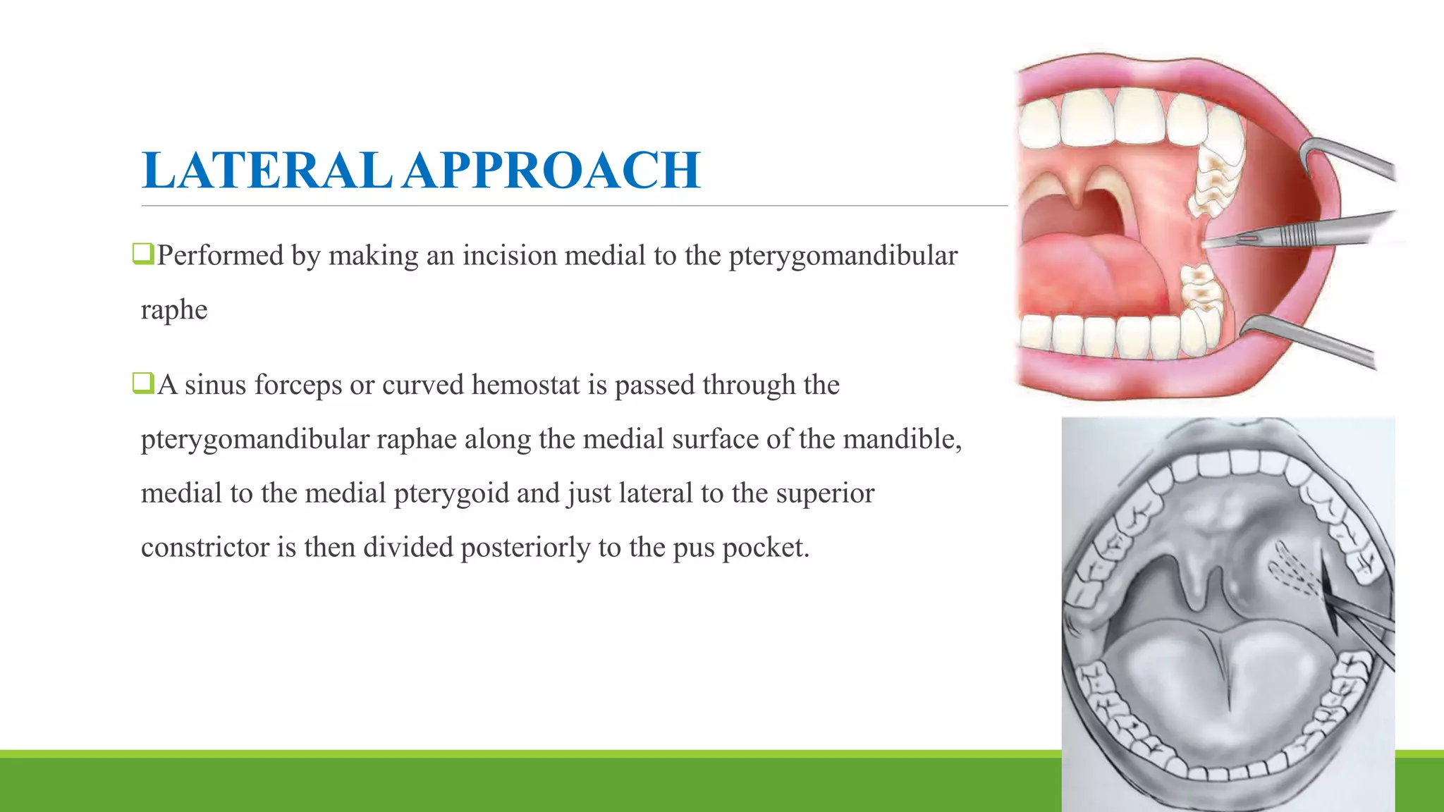 LATERALAPPROACH
Performed by making an incision medial to the pterygomandibular
raphe
A sinus forceps or curved hemostat is passed through the
pterygomandibular raphae along the medial surface of the mandible,
medial to the medial pterygoid and just lateral to the superior
constrictor is then divided posteriorly to the pus pocket.
88
 