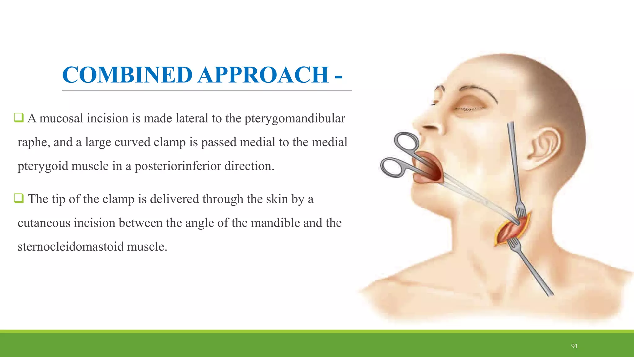 COMBINED APPROACH -
 A mucosal incision is made lateral to the pterygomandibular
raphe, and a large curved clamp is passed medial to the medial
pterygoid muscle in a posteriorinferior direction.
 The tip of the clamp is delivered through the skin by a
cutaneous incision between the angle of the mandible and the
sternocleidomastoid muscle.
91
 