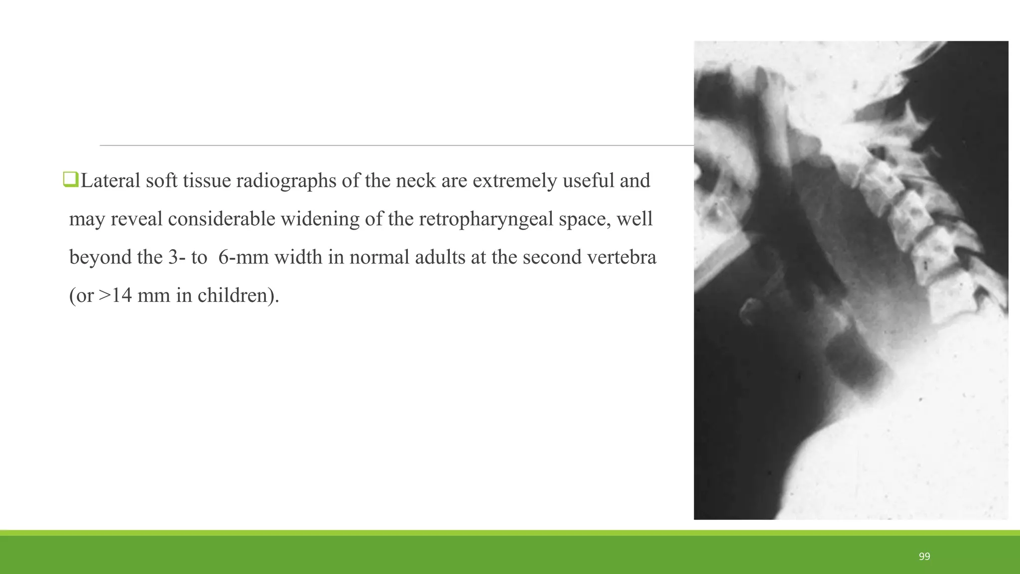 Lateral soft tissue radiographs of the neck are extremely useful and
may reveal considerable widening of the retropharyngeal space, well
beyond the 3- to 6-mm width in normal adults at the second vertebra
(or >14 mm in children).
99
 