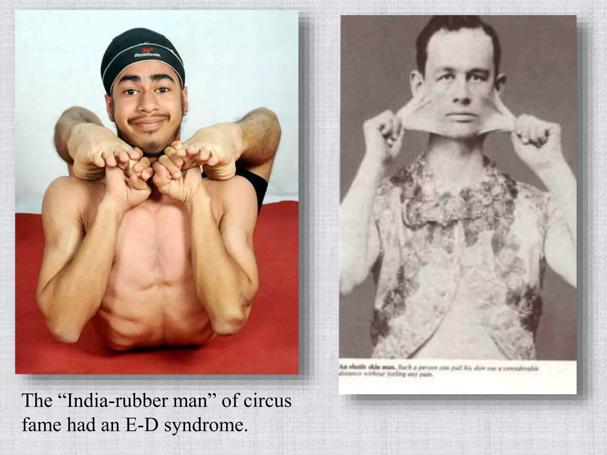 The “India-rubber man” of circus
fame had an E-D syndrome.
 