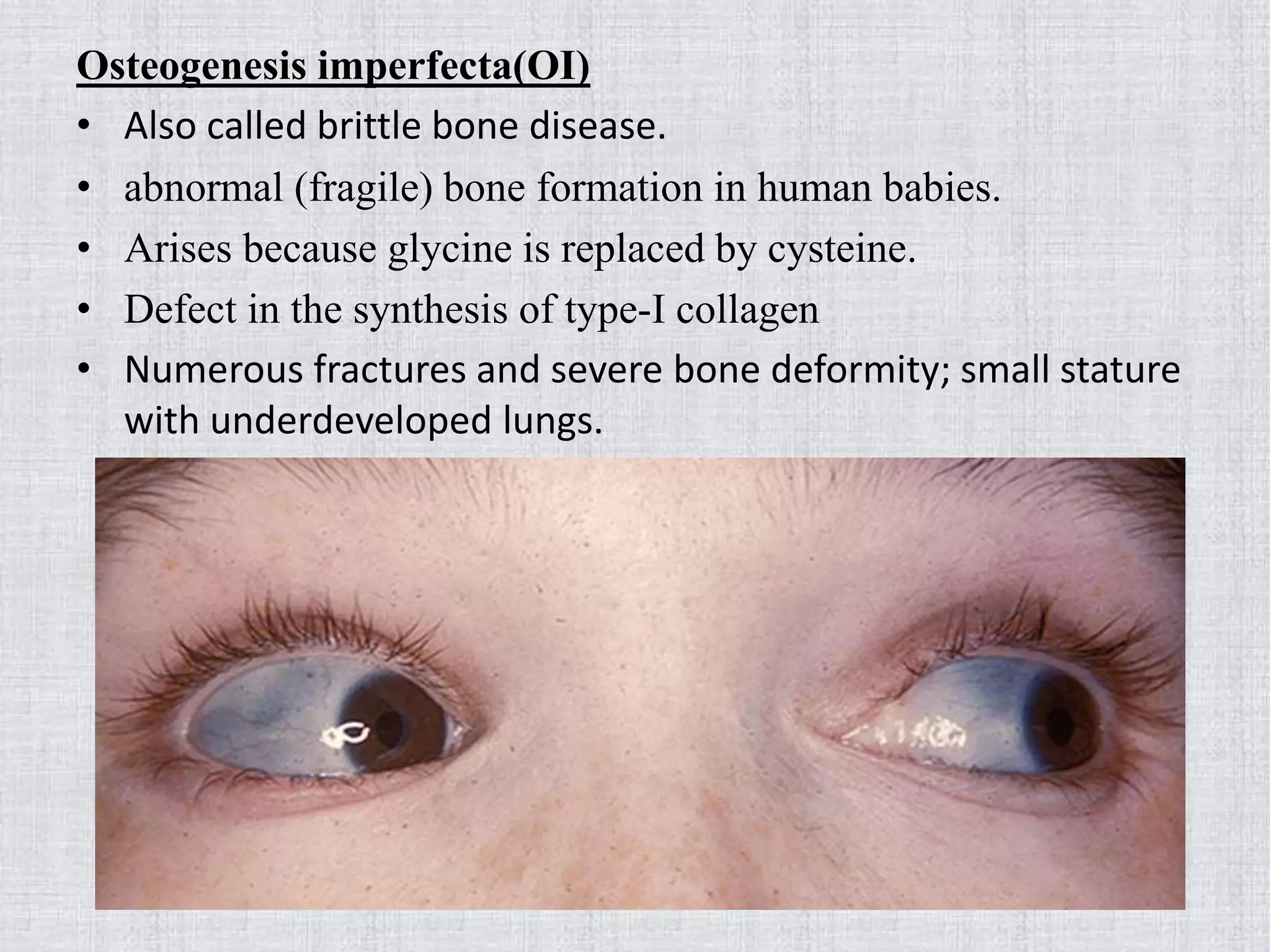 Osteogenesis imperfecta(OI)
• Also called brittle bone disease.
• abnormal (fragile) bone formation in human babies.
• Arises because glycine is replaced by cysteine.
• Defect in the synthesis of type-I collagen
• Numerous fractures and severe bone deformity; small stature
with underdeveloped lungs.
 