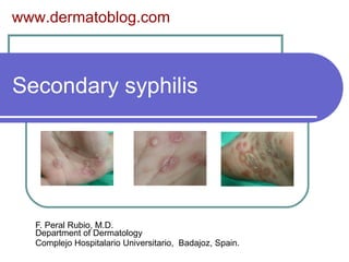Secondary syphilis F. Peral Rubio, M.D. Department of Dermatology Complejo Hospitalario Universitario, Badajoz, Spain. www.dermatoblog.com
