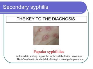 Secondary syphilis THE KEY TO THE DIAGNOSIS Papular syphilides A thin,white scaling ring on the surface of the lesion, known as Biette's collarette, is a helpful, although it is not pathognomonic .