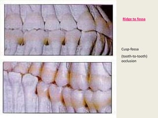 Cusp-fossa
(tooth-to-tooth)
occlusion
Ridge to fossa
 