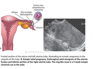 Chorionic Ring Comprehensive Overview of Second Week Human Embryonic Development and ...
