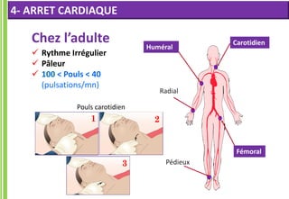 Carotidien
Radial
Pédieux
Chez l’adulte
 Rythme Irrégulier
 Pâleur
 100 < Pouls < 40
(pulsations/mn)
Pouls carotidien
1
3
2
Huméral
Fémoral
4- ARRET CARDIAQUE
 