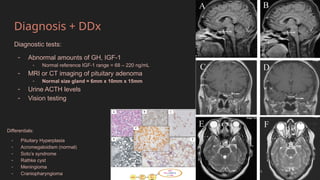 Secreting Pituitary Adenomaspresent.pptx