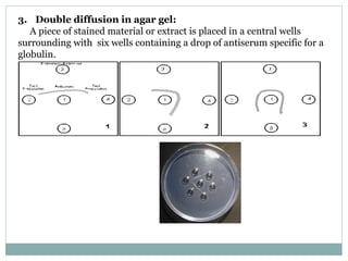 3. Double diffusion in agar gel:
A piece of stained material or extract is placed in a central wells
surrounding with six wells containing a drop of antiserum specific for a
globulin.
 