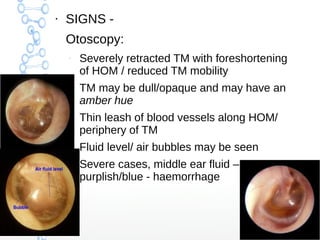 ●

SIGNS Otoscopy:
–

–

–

–

–

Severely retracted TM with foreshortening
of HOM / reduced TM mobility
TM may be dull/opaque and may have an
amber hue
Thin leash of blood vessels along HOM/
periphery of TM
Fluid level/ air bubbles may be seen
Severe cases, middle ear fluid –
purplish/blue - haemorrhage

 