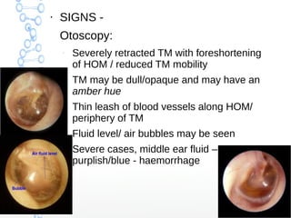 ●

SIGNS Otoscopy:
–

–

–

–

–

Severely retracted TM with foreshortening
of HOM / reduced TM mobility
TM may be dull/op...