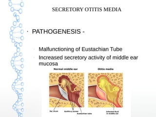SECRETORY OTITIS MEDIA

●

PATHOGENESIS –

–

Malfunctioning of Eustachian Tube
Increased secretory activity of middle ear...