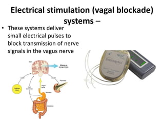 Electrical stimulation (vagal blockade)
systems –
• These systems deliver
small electrical pulses to
block transmission of nerve
signals in the vagus nerve
 