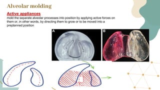 Positional Molding Cleft lip and palate and prosthesis neonates | PDF