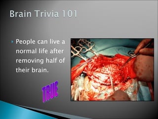 People can live a normal life after removing half of their brain.  TRUE 