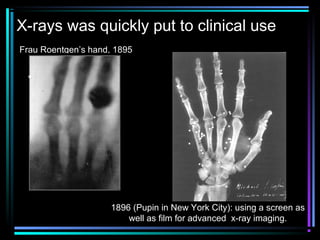 X-rays was quickly put to clinical use
Frau Roentgen’s hand, 1895




                     1896 (Pupin in New York City): using a screen as
                         well as film for advanced x-ray imaging.
 