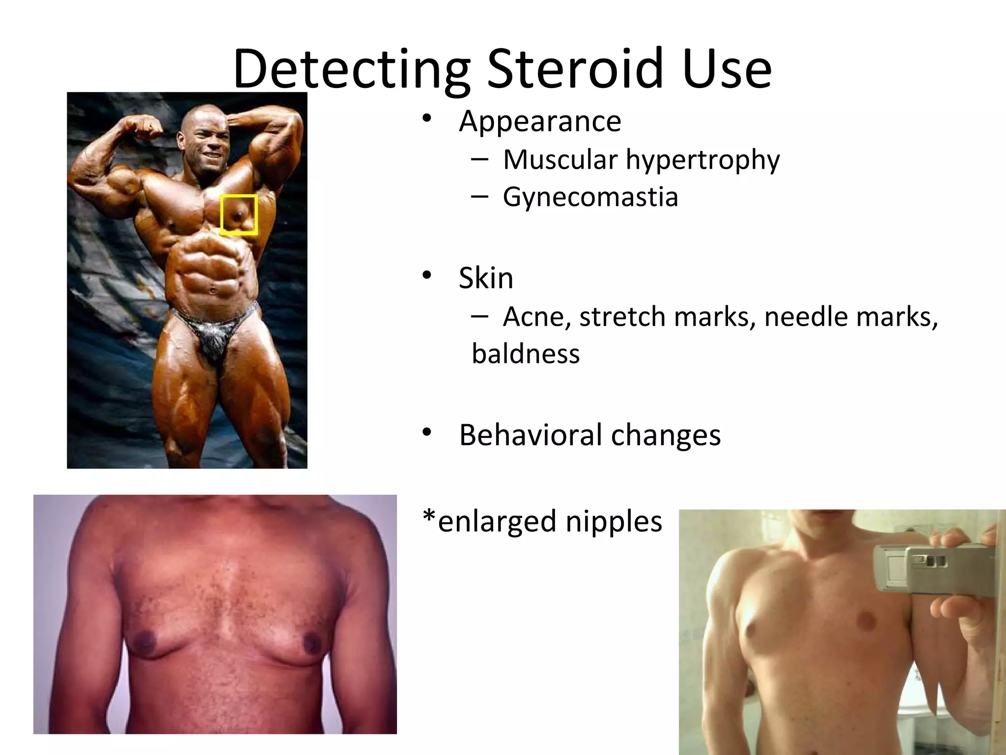 Detecting Steroid Use
       • Appearance
          – Muscular hypertrophy
          – Gynecomastia

       • Skin
          – Acne, stretch marks, needle marks,
          baldness

       • Behavioral changes

       *enlarged nipples
 