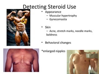 Detecting Steroid Use
       • Appearance
          – Muscular hypertrophy
          – Gynecomastia

       • Skin
          – Acne, stretch marks, needle marks,
          baldness

       • Behavioral changes

       *enlarged nipples
 