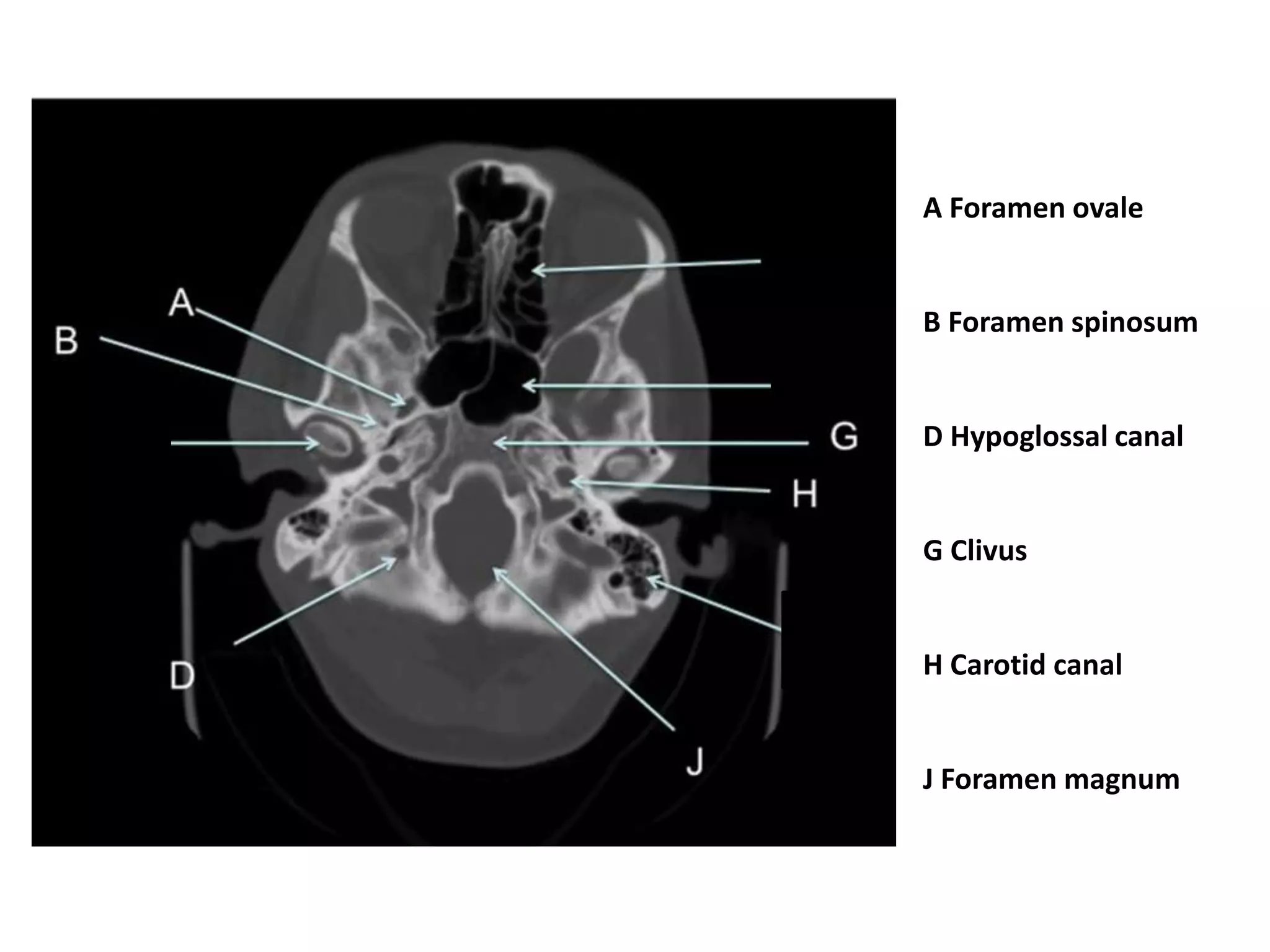 A Foramen ovale


B Foramen spinosum


D Hypoglossal canal


G Clivus


H Carotid canal


J Foramen magnum
 