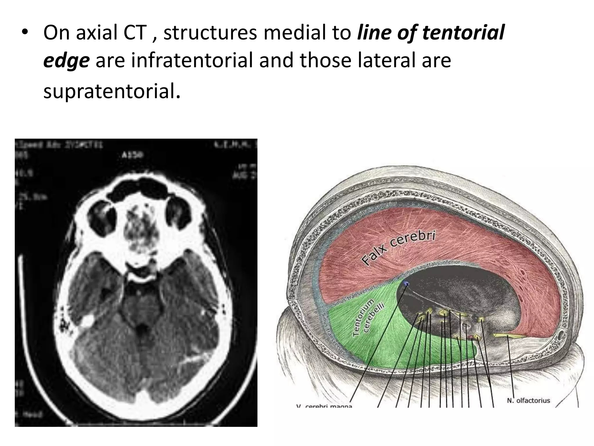 • On axial CT , structures medial to line of tentorial
  edge are infratentorial and those lateral are
  supratentorial.
 