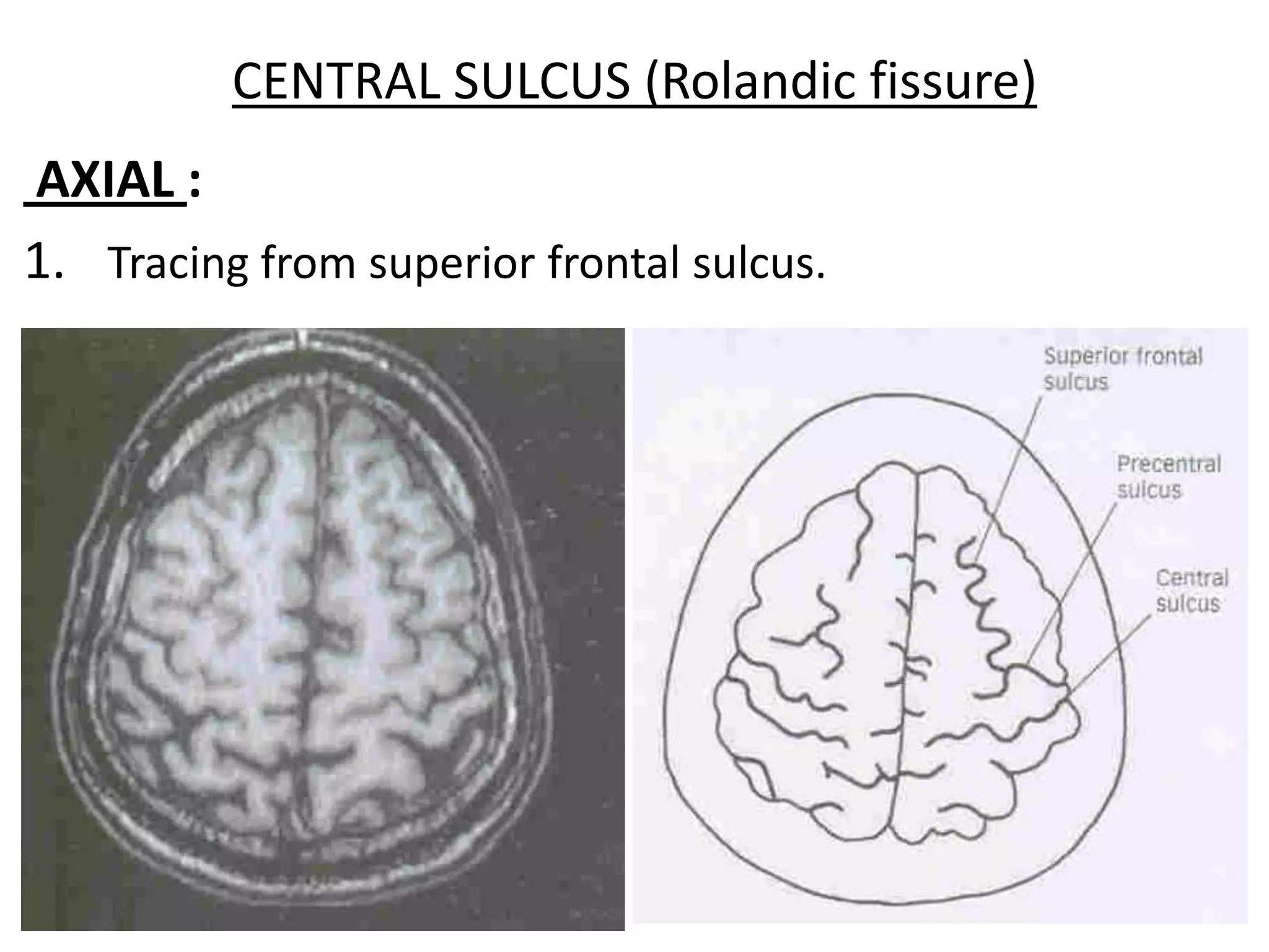 CENTRAL SULCUS (Rolandic fissure)
AXIAL :
1. Tracing from superior frontal sulcus.
 
