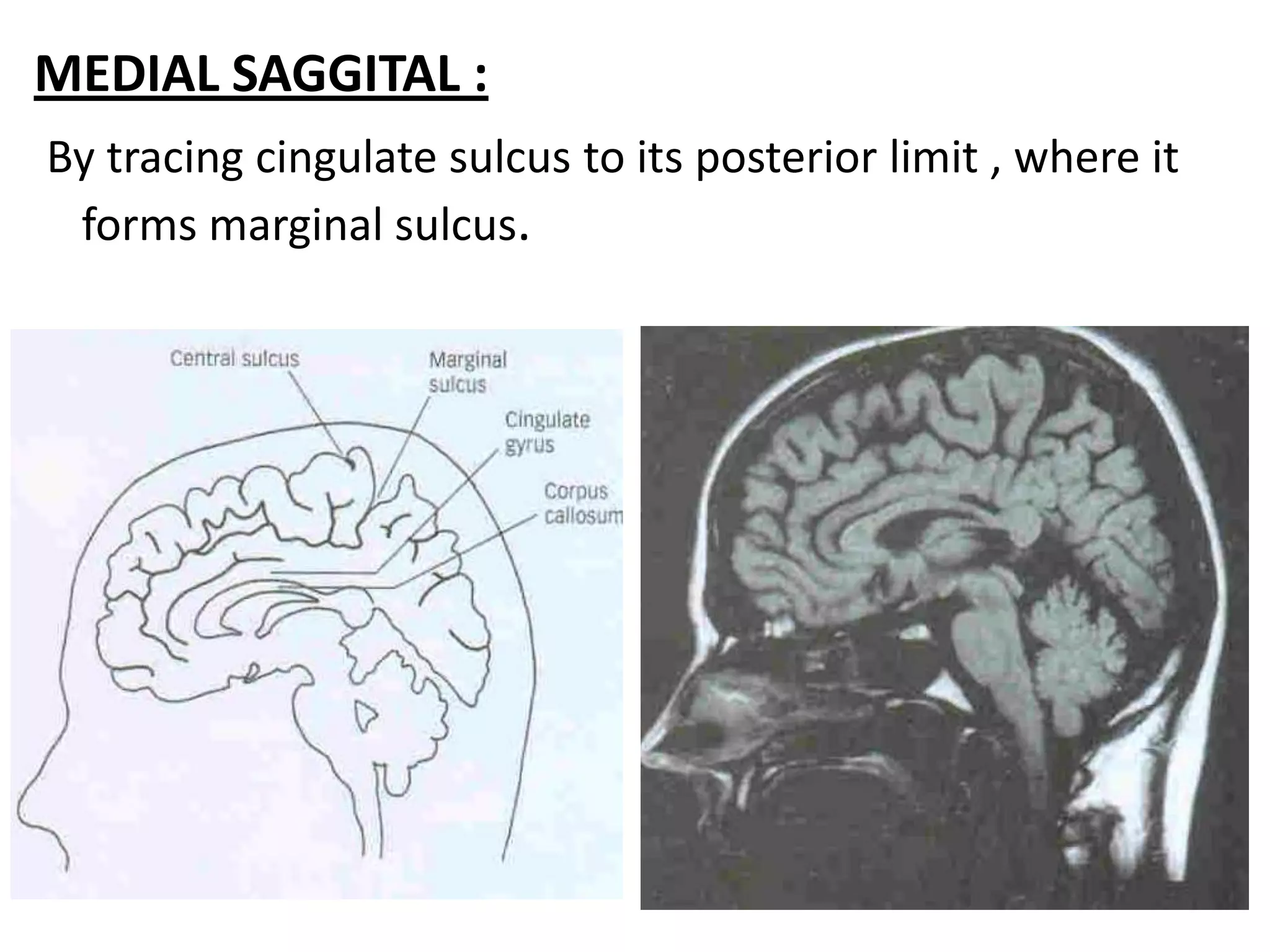 MEDIAL SAGGITAL :
By tracing cingulate sulcus to its posterior limit , where it
 forms marginal sulcus.
 