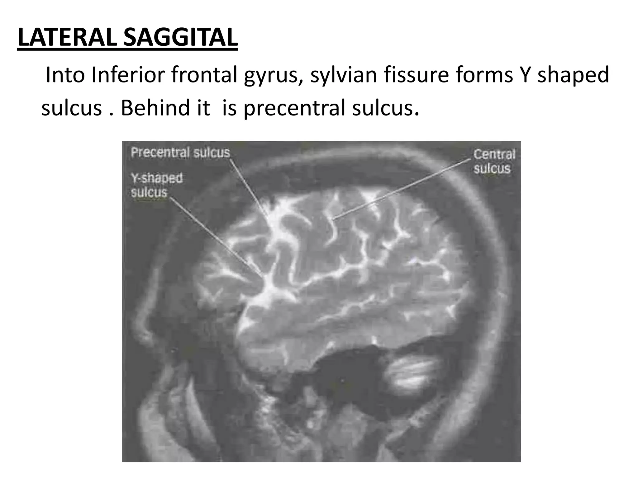 LATERAL SAGGITAL
 Into Inferior frontal gyrus, sylvian fissure forms Y shaped
 sulcus . Behind it is precentral sulcus.
 