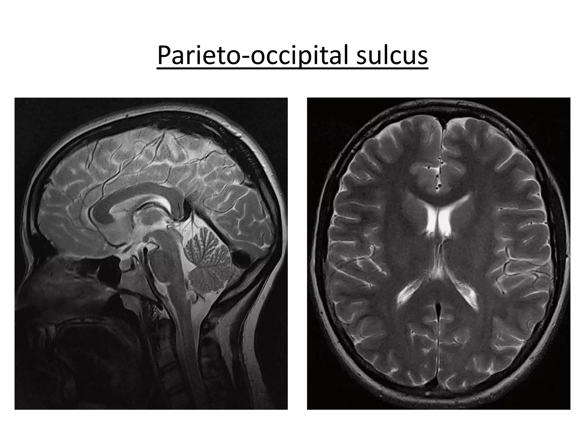 Parieto-occipital sulcus
 