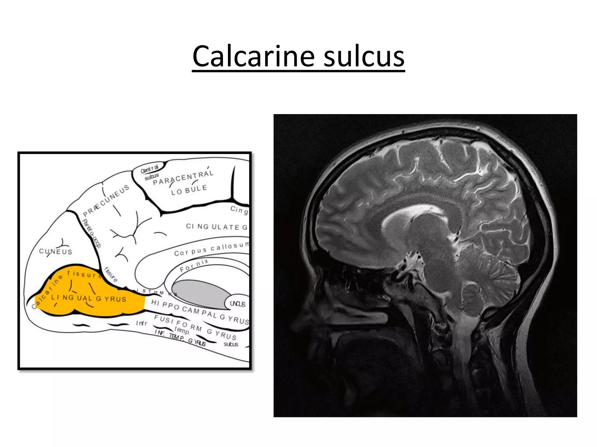 Calcarine sulcus
 
