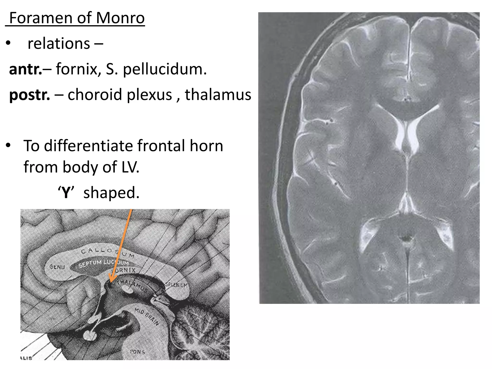 Foramen of Monro
• relations –
 antr.– fornix, S. pellucidum.
 postr. – choroid plexus , thalamus

• To differentiate frontal horn
  from body of LV.
       ‘Y’ shaped.
 