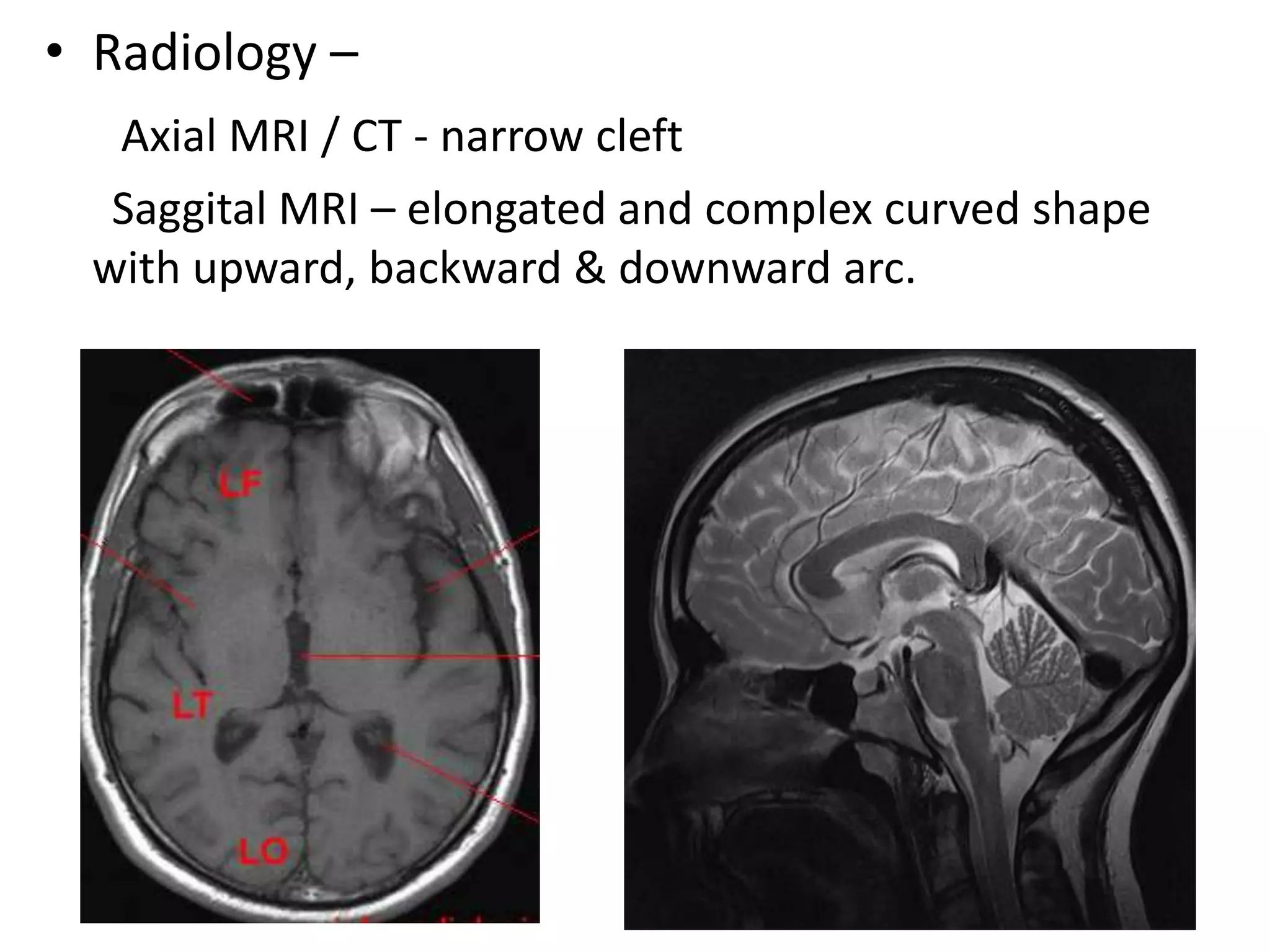 • Radiology –
  Axial MRI / CT - narrow cleft
  Saggital MRI – elongated and complex curved shape
 with upward, backward & downward arc.
 