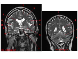 Imaging sectional anatomy of brain part 1 | PPTX