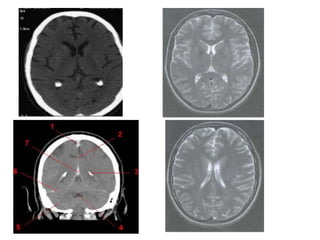 Sectional anatomy of brain part 1 | PPTX