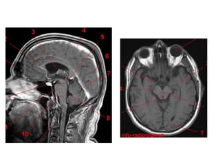 Sectional anatomy of brain part 1 | PPTX