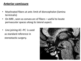 Imaging sectional anatomy of brain part 2 | PPTX