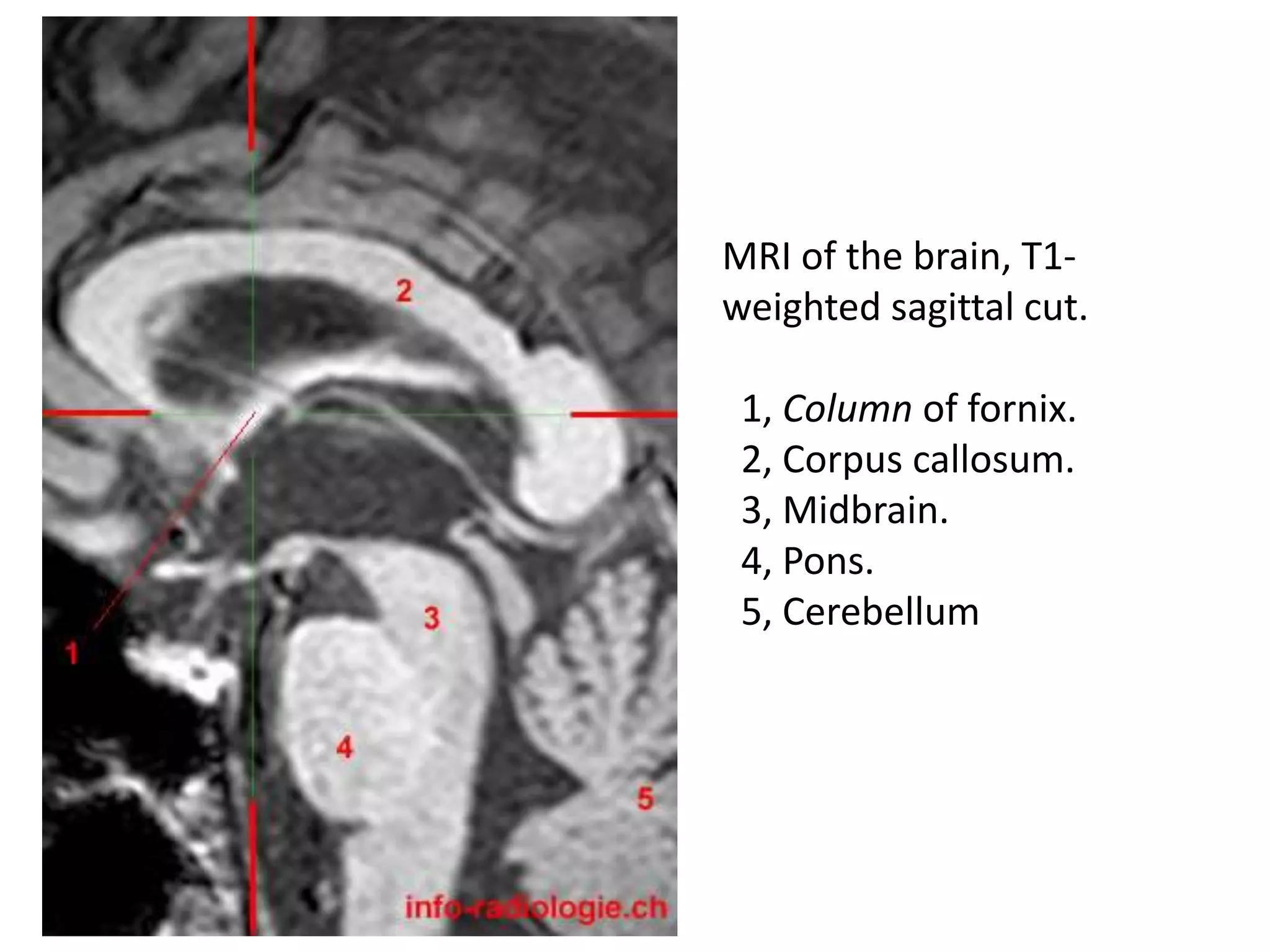 Sectional anatomy of brain part 2 | PPTX