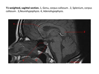 Genu Splenum Sectional anatomy of brain part 2 | PPTX