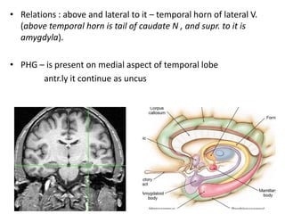 Uncus Temporal Sectional anatomy of brain part 2 | PPTX