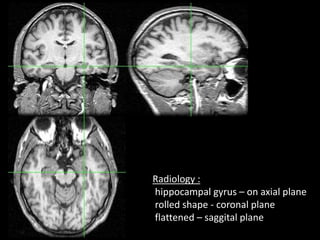 Sectional anatomy of brain part 2 | PPTX