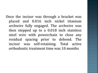 Once the incisor was through a bracket was
placed and 0.016 inch nickel titanium
archwire fully engaged. The archwire was
then stepped up to a 0.018 inch stainless
steel wire with powerchain to close any
residual spacing prior to debond. The
incisor was self-retaining. Total active
orthodontic treatment time was 10 months
 