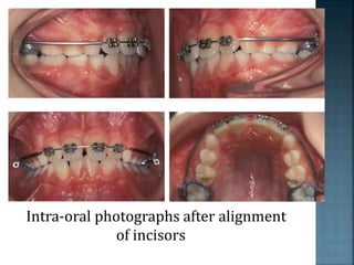 Intra-oral photographs after alignment
of incisors
 