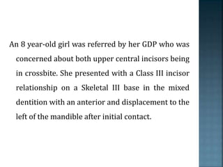 An 8 year-old girl was referred by her GDP who was
concerned about both upper central incisors being
in crossbite. She presented with a Class III incisor
relationship on a Skeletal III base in the mixed
dentition with an anterior and displacement to the
left of the mandible after initial contact.
 