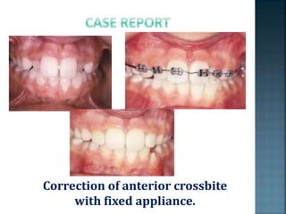 Correction of anterior crossbite
with fixed appliance.
 